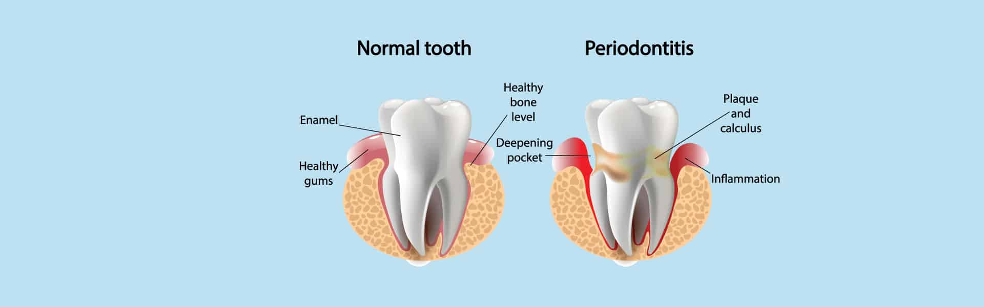 Periodontal Disease Periodontal Disease