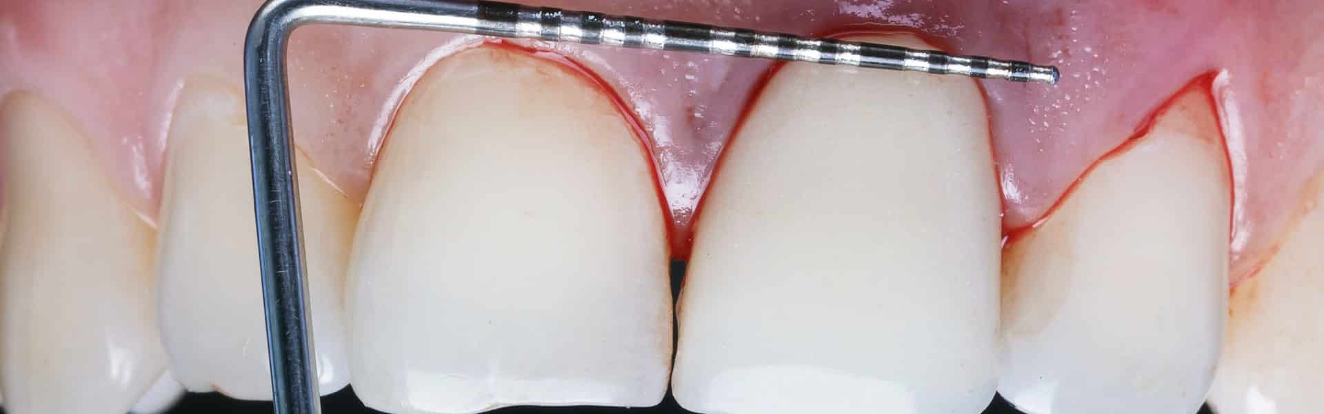 Periodontal Surgery