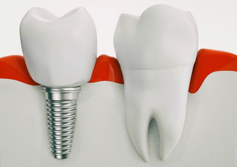 Single Tooth Implant