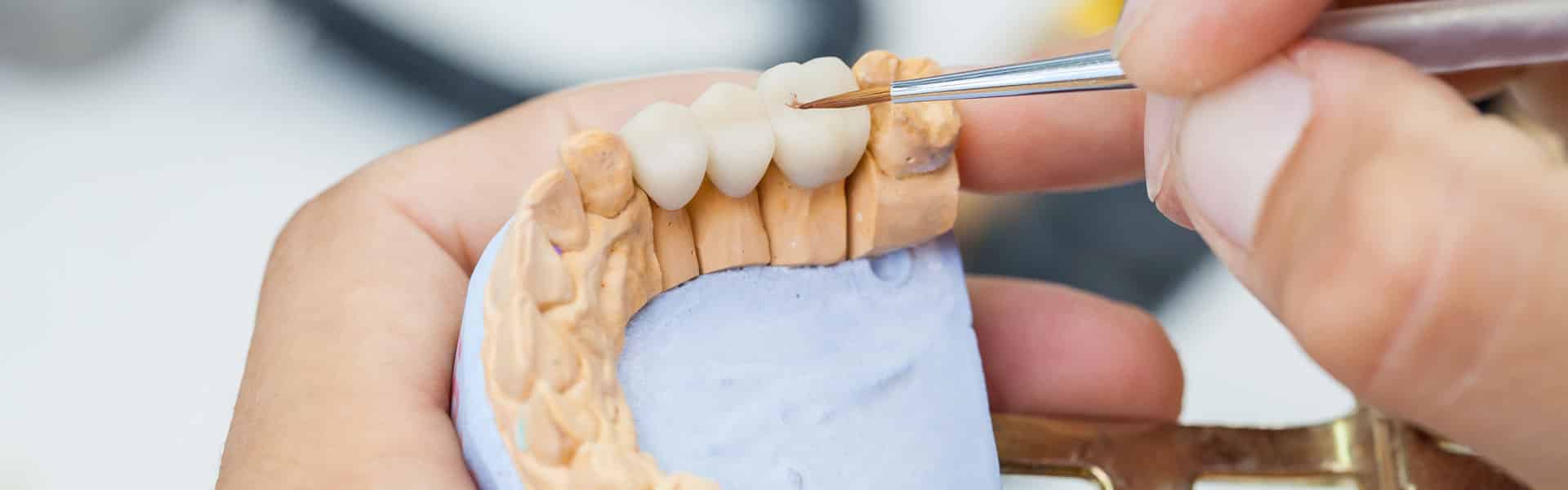 Dental Bridges Dental Bridges
