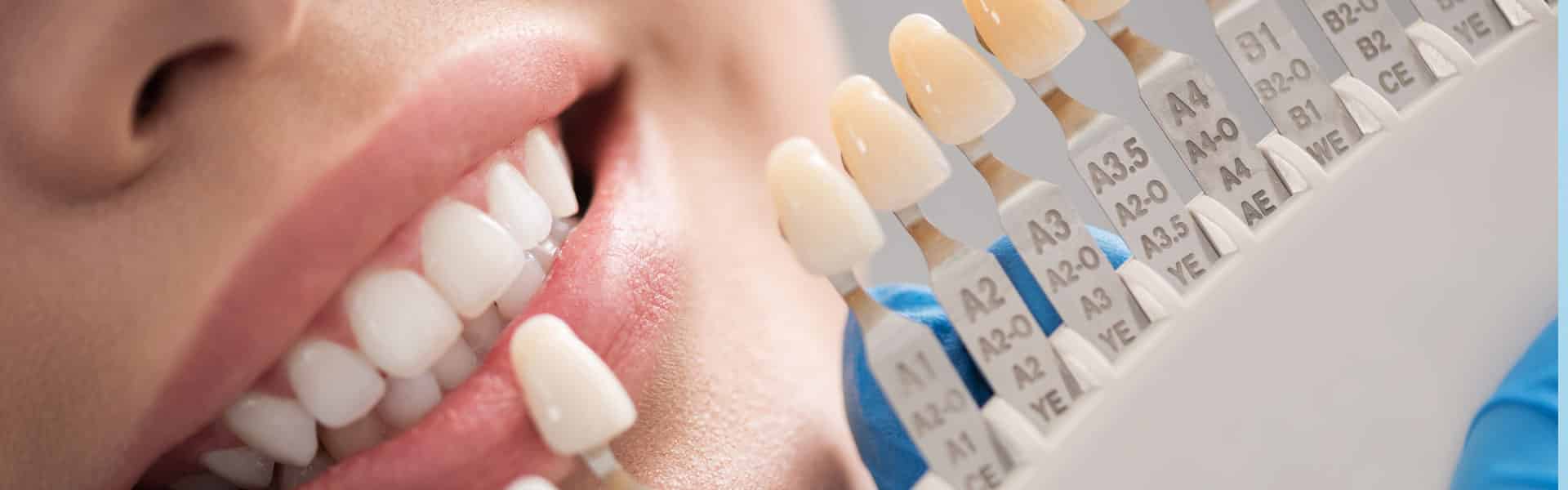 Dental Crowns Dental Crowns