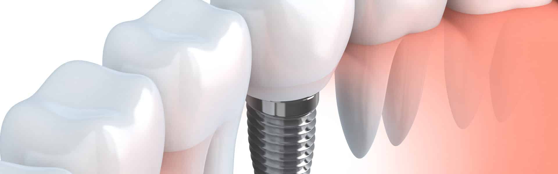 Dental Implants