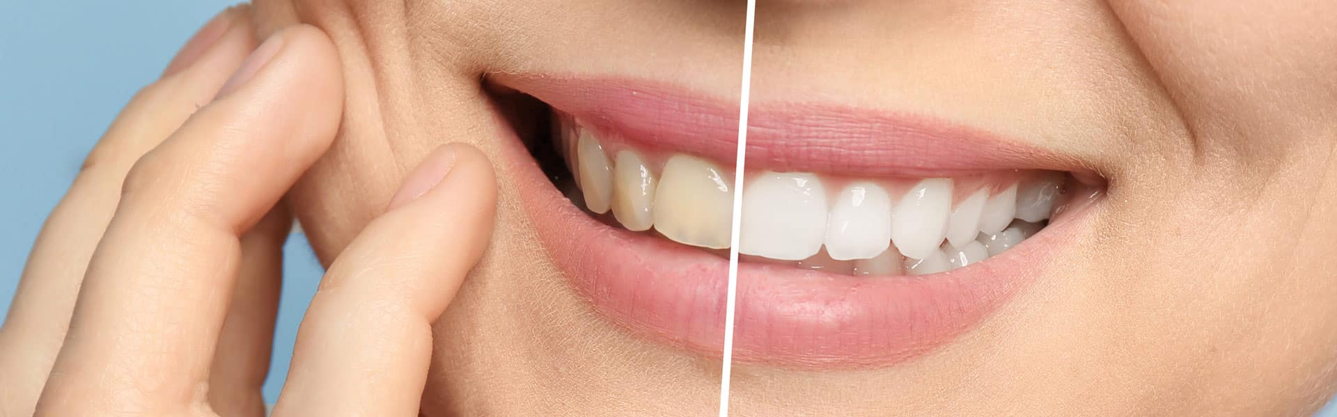 Teeth Whitening Teeth Whitening
