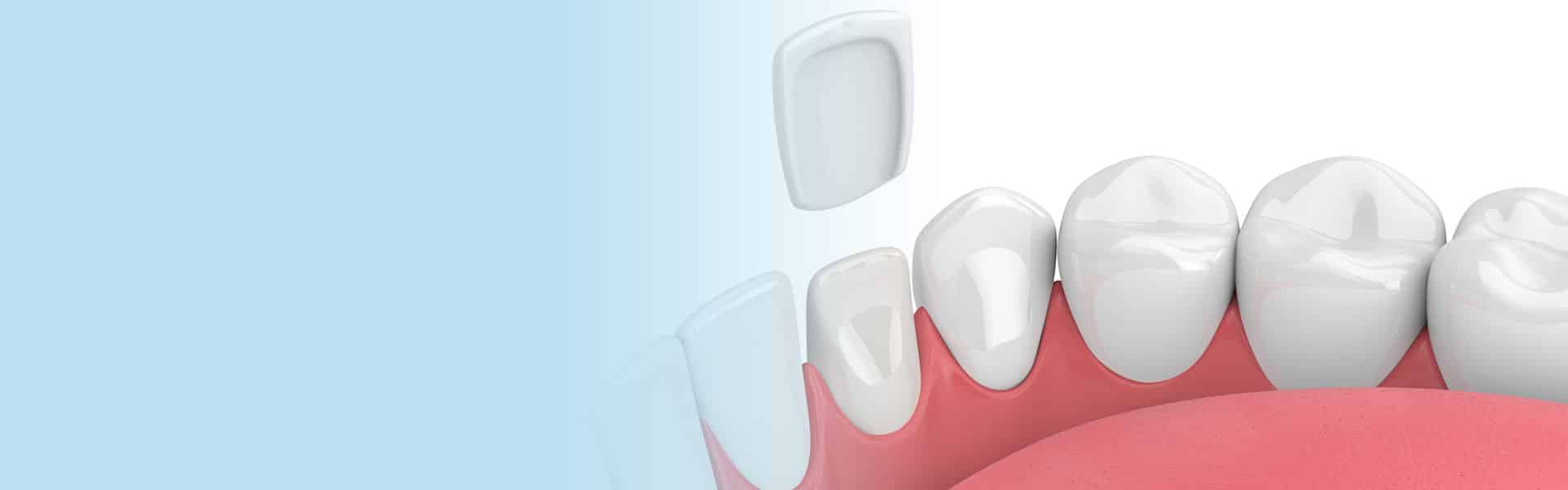 veneers veneers