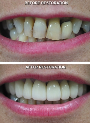 full mouth reconstruction dentist in Seminole